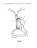 EQUIPMENT TO APPROXIMATE TISSUE PORTIONS, WHICH ARE INTENED TO FORM AN     ANASTOMOSIS, AND A METHOD FOR PERFORMING ANASTOMOSES IN TRACTS OF THE     DIGESTIVE TUBE diagram and image