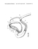 EQUIPMENT TO APPROXIMATE TISSUE PORTIONS, WHICH ARE INTENED TO FORM AN     ANASTOMOSIS, AND A METHOD FOR PERFORMING ANASTOMOSES IN TRACTS OF THE     DIGESTIVE TUBE diagram and image