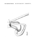 EQUIPMENT TO APPROXIMATE TISSUE PORTIONS, WHICH ARE INTENED TO FORM AN     ANASTOMOSIS, AND A METHOD FOR PERFORMING ANASTOMOSES IN TRACTS OF THE     DIGESTIVE TUBE diagram and image