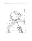 EQUIPMENT TO APPROXIMATE TISSUE PORTIONS, WHICH ARE INTENED TO FORM AN     ANASTOMOSIS, AND A METHOD FOR PERFORMING ANASTOMOSES IN TRACTS OF THE     DIGESTIVE TUBE diagram and image