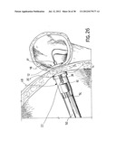 EQUIPMENT TO APPROXIMATE TISSUE PORTIONS, WHICH ARE INTENED TO FORM AN     ANASTOMOSIS, AND A METHOD FOR PERFORMING ANASTOMOSES IN TRACTS OF THE     DIGESTIVE TUBE diagram and image