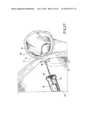 EQUIPMENT TO APPROXIMATE TISSUE PORTIONS, WHICH ARE INTENED TO FORM AN     ANASTOMOSIS, AND A METHOD FOR PERFORMING ANASTOMOSES IN TRACTS OF THE     DIGESTIVE TUBE diagram and image