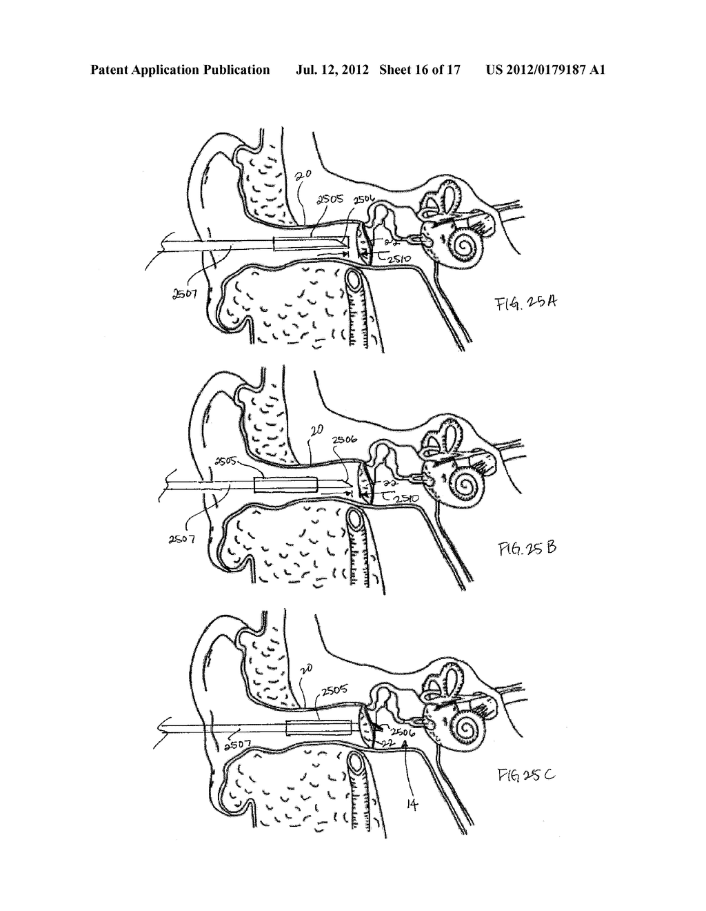 STABILIZATION SYSTEM AND ASPIRATION DEVICE WITH PROTECTED CUTTING EDGE - diagram, schematic, and image 17