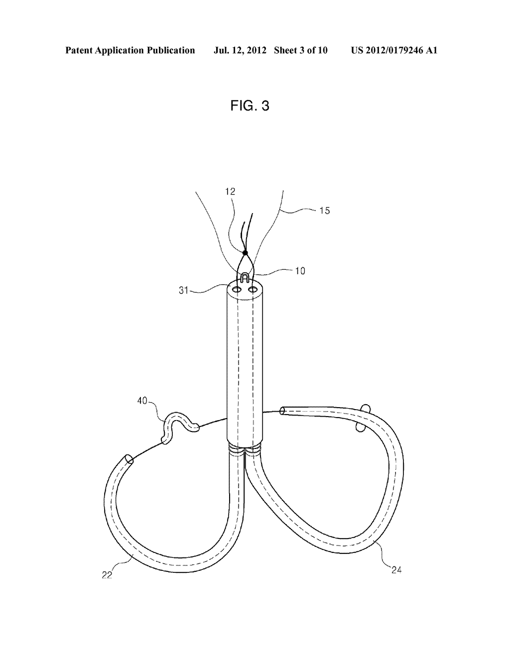 MITRAL VALVE CERCLARGE ANNULOPLASTY APPRATUS AND METHOD THEREOF - diagram, schematic, and image 04