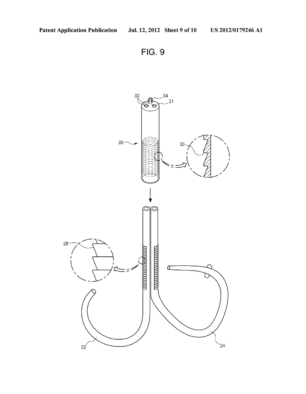 MITRAL VALVE CERCLARGE ANNULOPLASTY APPRATUS AND METHOD THEREOF - diagram, schematic, and image 10