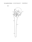 HUMERAL COMPONENT OF A SHOULDER PROSTHESIS AND METHODS OF SHOULDER     ARTHROPLASTY diagram and image