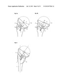 HUMERAL COMPONENT OF A SHOULDER PROSTHESIS AND METHODS OF SHOULDER     ARTHROPLASTY diagram and image