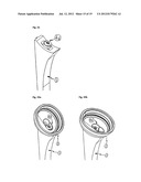 HUMERAL COMPONENT OF A SHOULDER PROSTHESIS AND METHODS OF SHOULDER     ARTHROPLASTY diagram and image