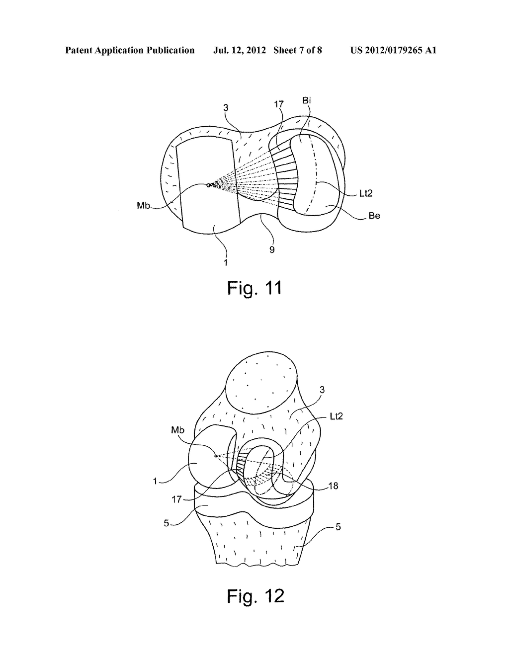 KNEE PROSTHESIS - diagram, schematic, and image 08