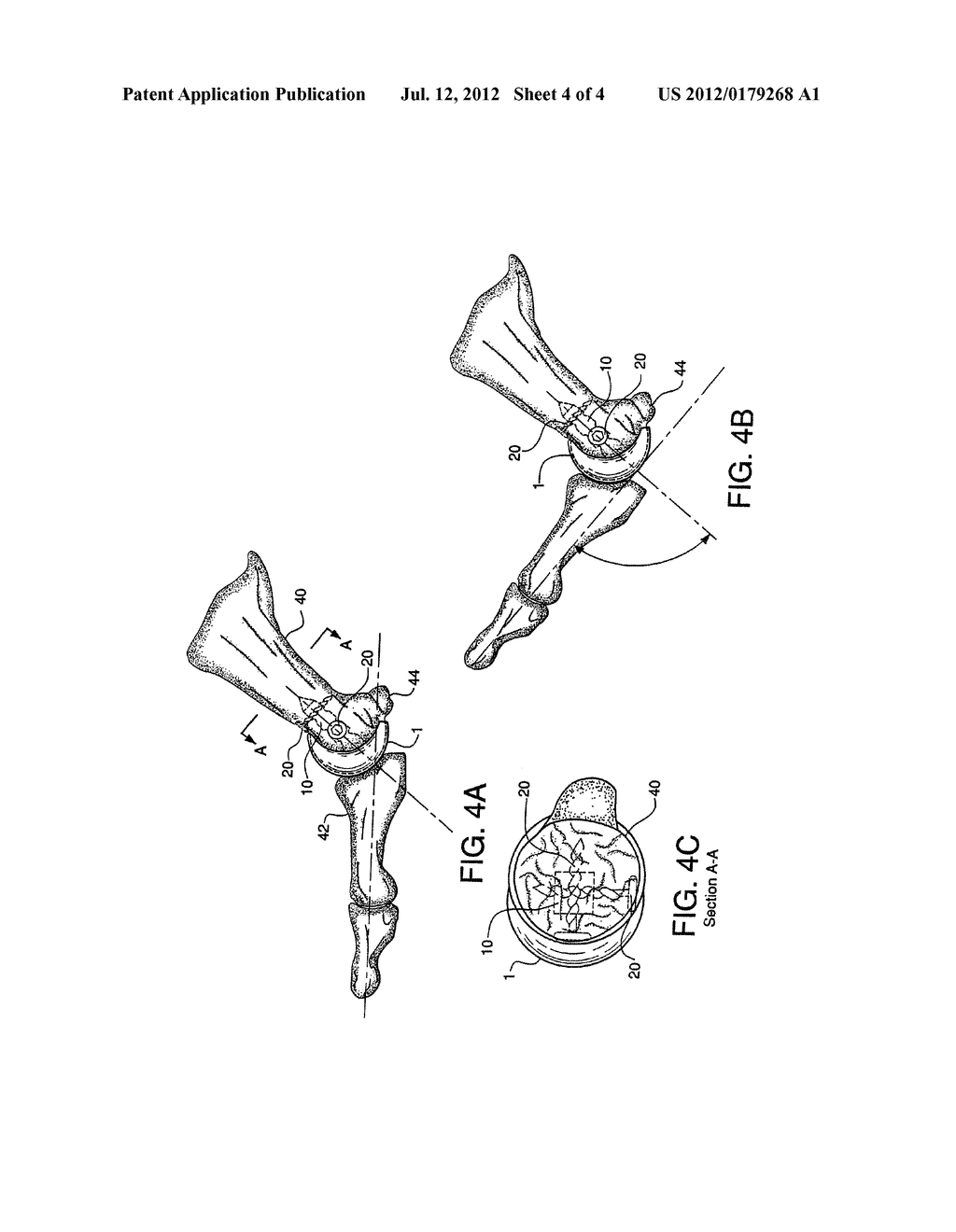 Metatarsal Implant - diagram, schematic, and image 05