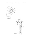 CONSTRAINED ACETABULAR TRIALING SYSTEM diagram and image