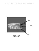 SYSTEMS FOR DENTURE PREPARATION diagram and image