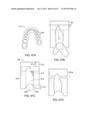 SYSTEMS FOR DENTURE PREPARATION diagram and image