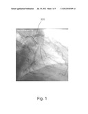 VASCULAR ROADMAPPING diagram and image