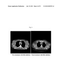  USE OF INHIBITORS OF BRUTON S TYROSINE KINASE (BTK) diagram and image