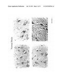 DIAGNOSIS AND TREATMENT OF NEUROECTODERMAL TUMORS diagram and image