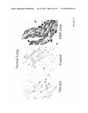 DIAGNOSIS AND TREATMENT OF NEUROECTODERMAL TUMORS diagram and image