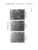 DIAGNOSIS AND TREATMENT OF NEUROECTODERMAL TUMORS diagram and image