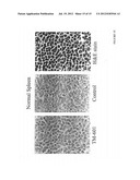 DIAGNOSIS AND TREATMENT OF NEUROECTODERMAL TUMORS diagram and image