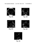 INHIBITORS OF HEDGEHOG SIGNALING PATHWAYS, COMPOSITIONS AND USES RELATED     THERETO diagram and image