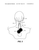 POM POM Device diagram and image