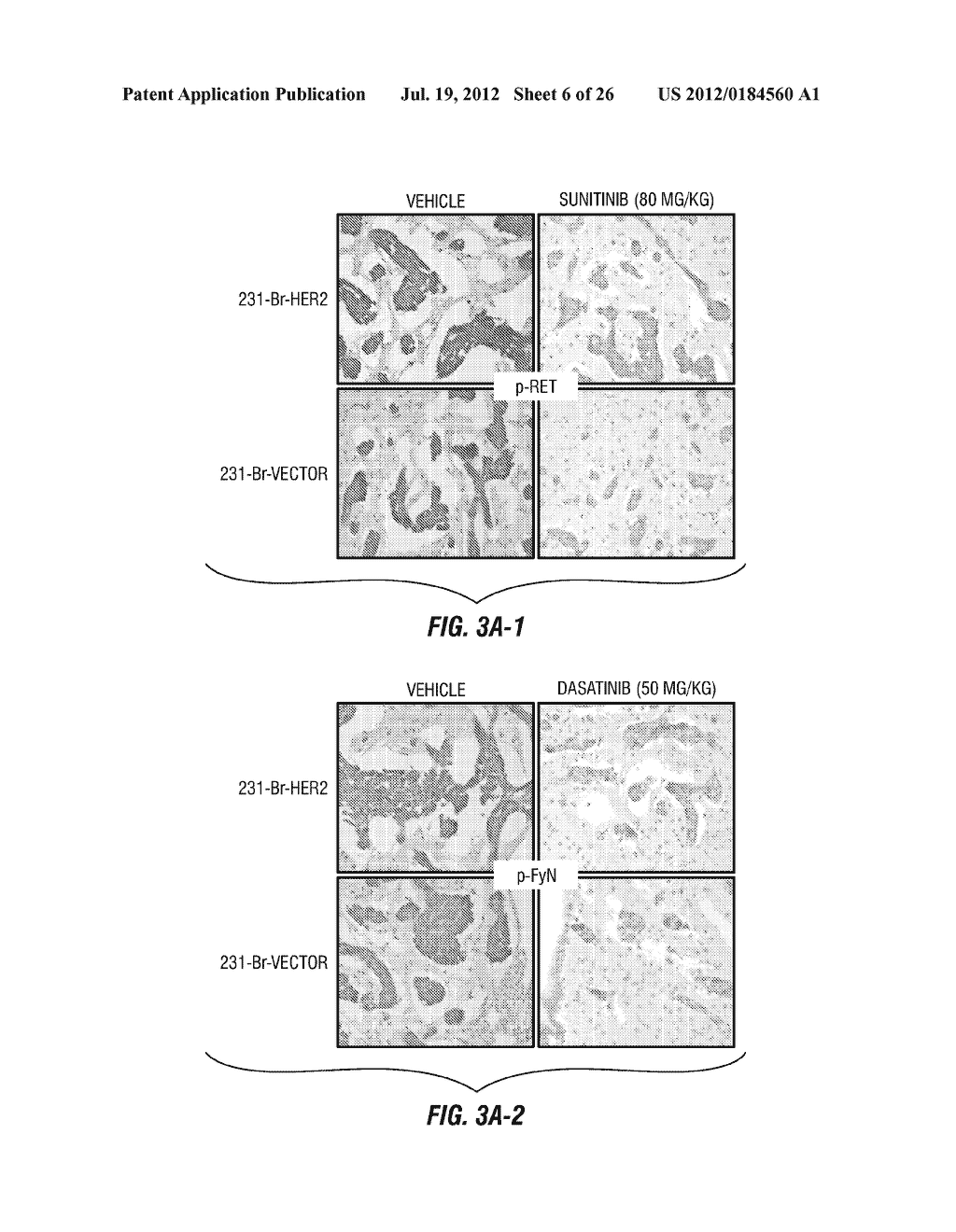 MOLECULAR DIAGNOSTIC METHODS FOR PREDICTING BRAIN METASTASIS OF BREAST     CANCER - diagram, schematic, and image 07