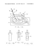 METHOD AND APPARATUS FOR DELIVERY INTO THE FETAL TRACHEA diagram and image