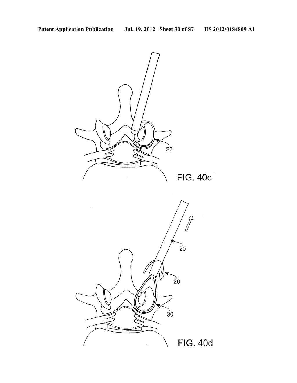 DEVICES AND METHODS FOR TISSUE MODIFICATION - diagram, schematic, and image 31