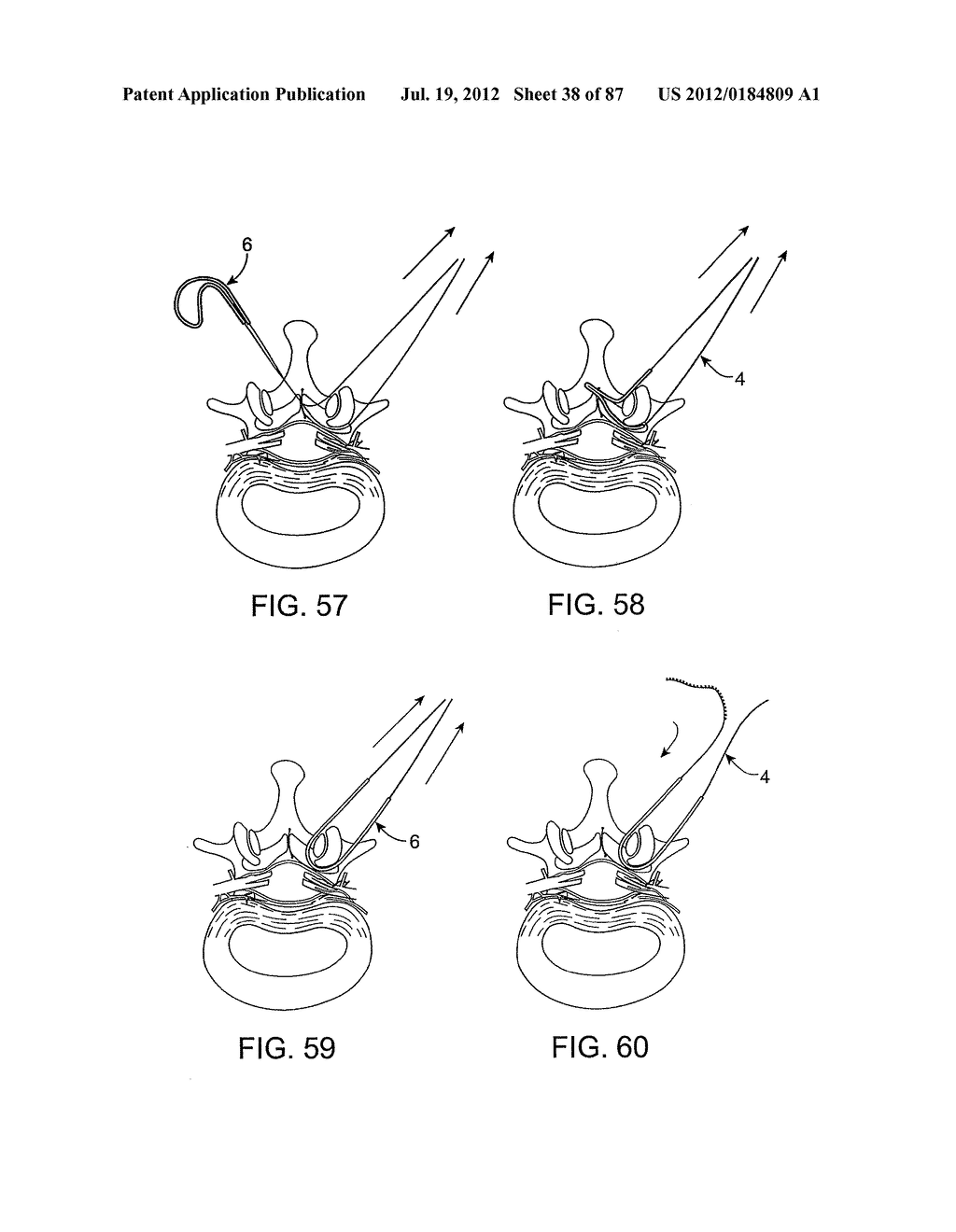 DEVICES AND METHODS FOR TISSUE MODIFICATION - diagram, schematic, and image 39