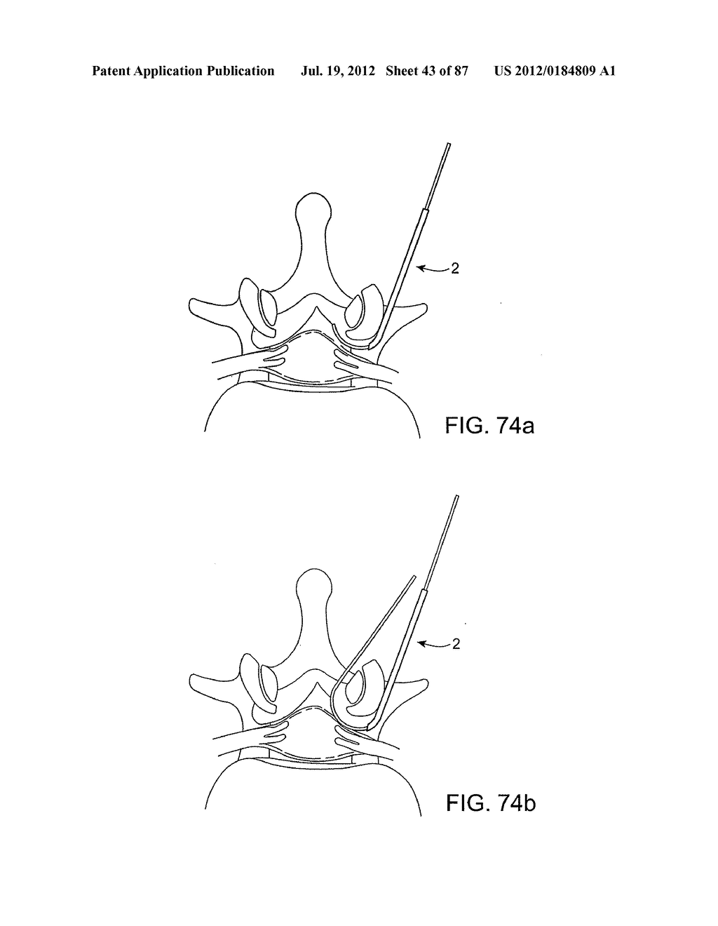 DEVICES AND METHODS FOR TISSUE MODIFICATION - diagram, schematic, and image 44