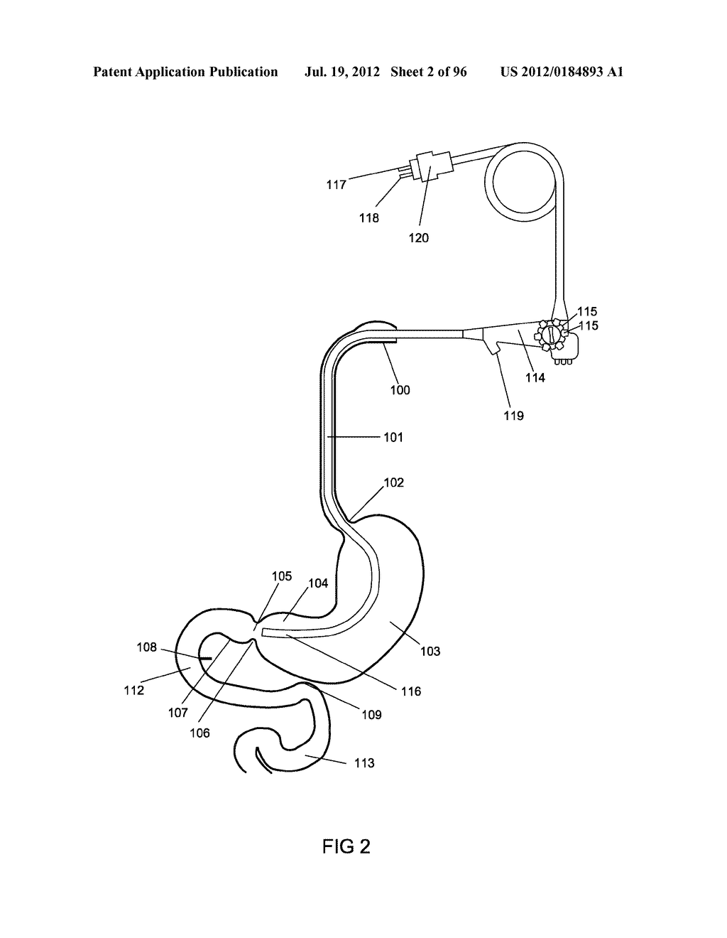 ANCHORS AND METHODS FOR INTESTINAL BYPASS SLEEVES - diagram, schematic, and image 03