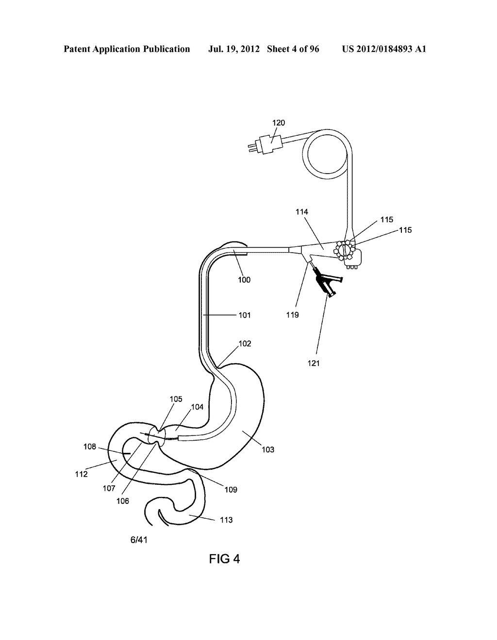 ANCHORS AND METHODS FOR INTESTINAL BYPASS SLEEVES - diagram, schematic, and image 05