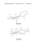 CATHETER INSERTION DEVICE diagram and image