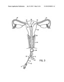 ASSEMBLY AND KIT FOR MARKING TUBAL OSTIA diagram and image