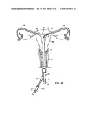 ASSEMBLY AND KIT FOR MARKING TUBAL OSTIA diagram and image