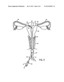 ASSEMBLY AND KIT FOR MARKING TUBAL OSTIA diagram and image