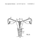 ASSEMBLY AND KIT FOR MARKING TUBAL OSTIA diagram and image