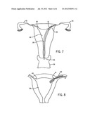 ASSEMBLY AND KIT FOR MARKING TUBAL OSTIA diagram and image