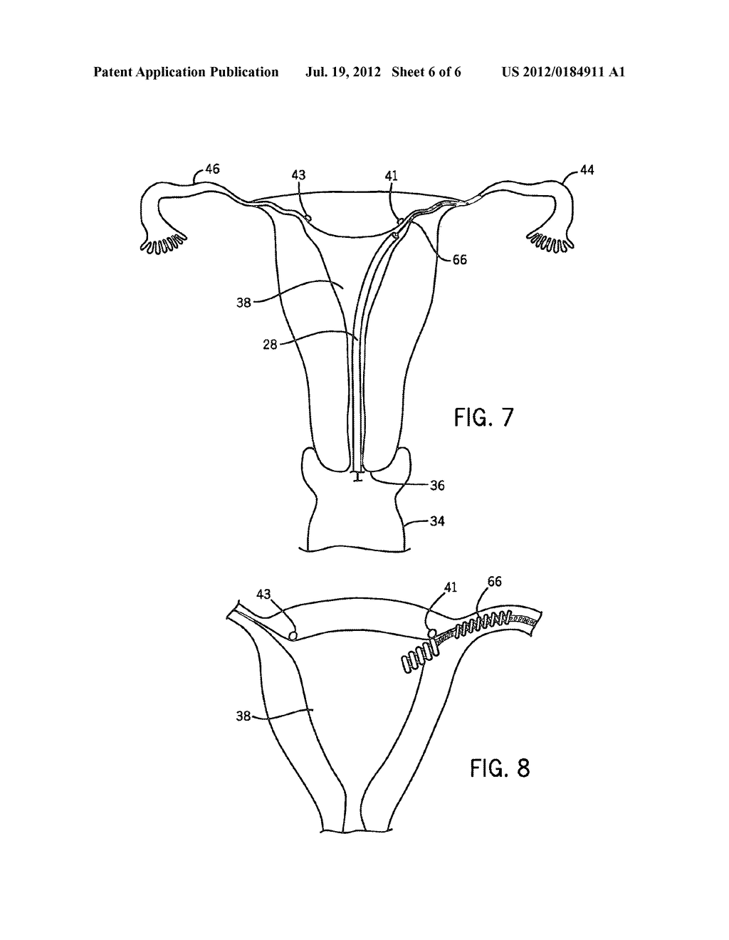 ASSEMBLY AND KIT FOR MARKING TUBAL OSTIA - diagram, schematic, and image 07