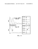 Apparatus and Methods for Guiding Catheter-Based Ablation Therapy for     Ventricular Arrhythmias Based on Spectral Mapping During Sinus Rhythm diagram and image