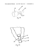 EXCHANGEABLE SYSTEM FOR MINIMALLY INVASIVE BEATING HEART REPAIR OF HEART     VALVE LEAFLETS diagram and image