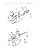 EXCHANGEABLE SYSTEM FOR MINIMALLY INVASIVE BEATING HEART REPAIR OF HEART     VALVE LEAFLETS diagram and image