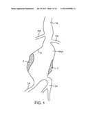 Methods and Systems for Treating Aneurysms diagram and image