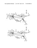 Methods and Systems for Treating Aneurysms diagram and image