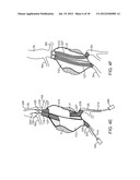 Methods and Systems for Treating Aneurysms diagram and image