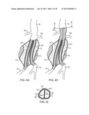 Methods and Systems for Treating Aneurysms diagram and image