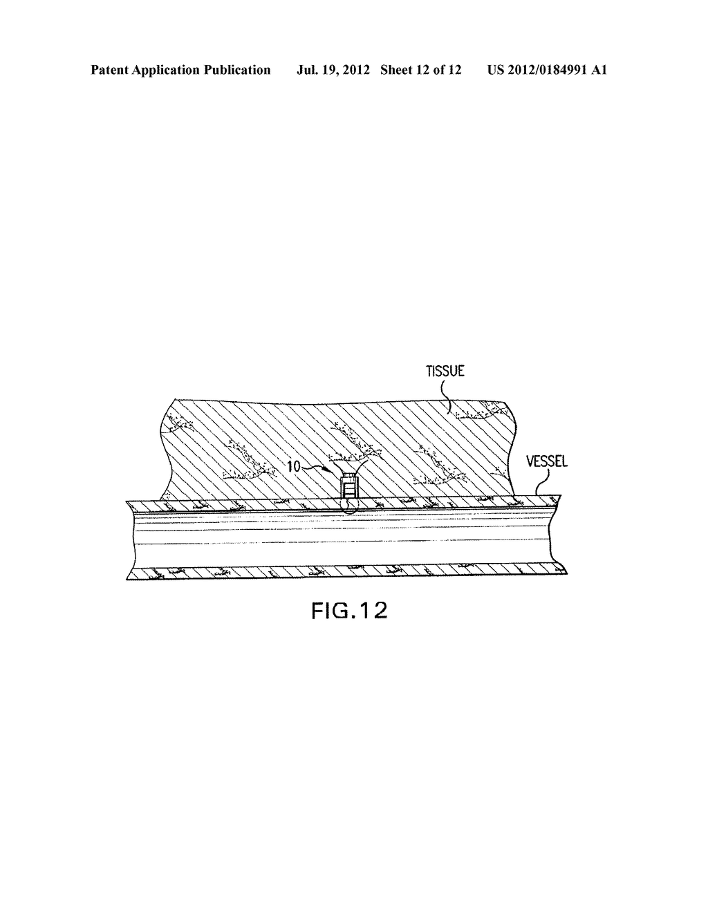 SUTURE LOCKING DEVICE AND METHODS - diagram, schematic, and image 13