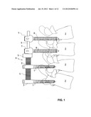 VERTEBRAL COLUMN IMPLANT diagram and image