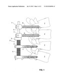 VERTEBRAL COLUMN IMPLANT diagram and image