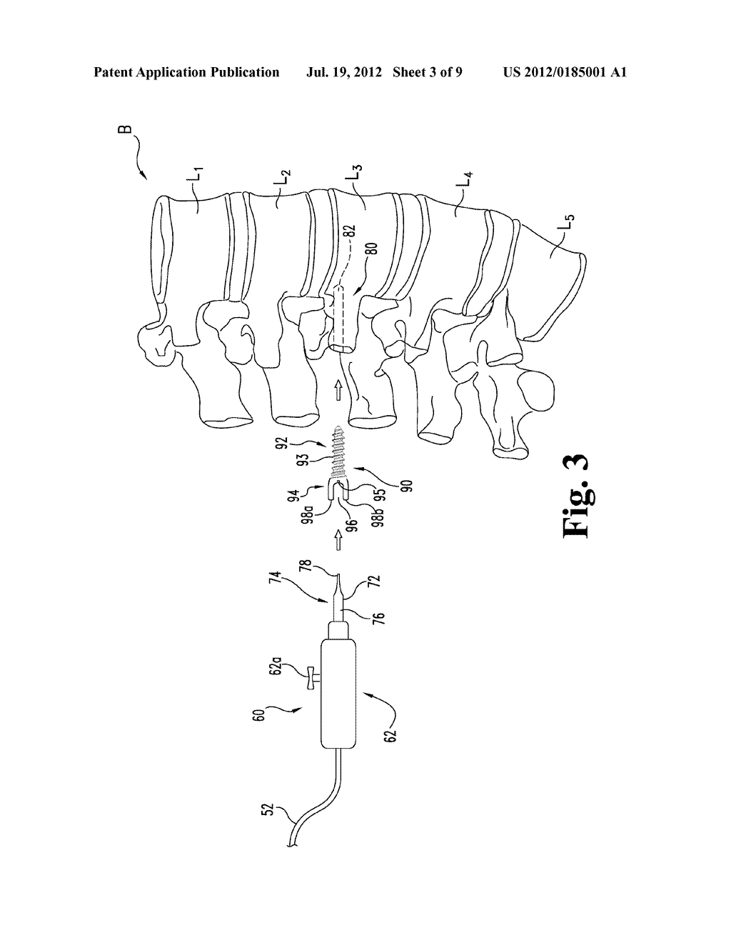 Bone Anchors Compatible for Use with Neural Integrity Monitoring Systems     and Procedures - diagram, schematic, and image 04